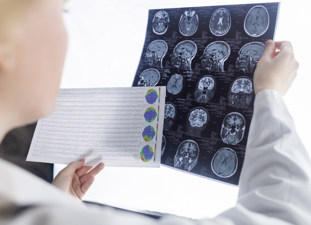 Diagnostika epilepsie a vyšetrenie činnosti mozgu